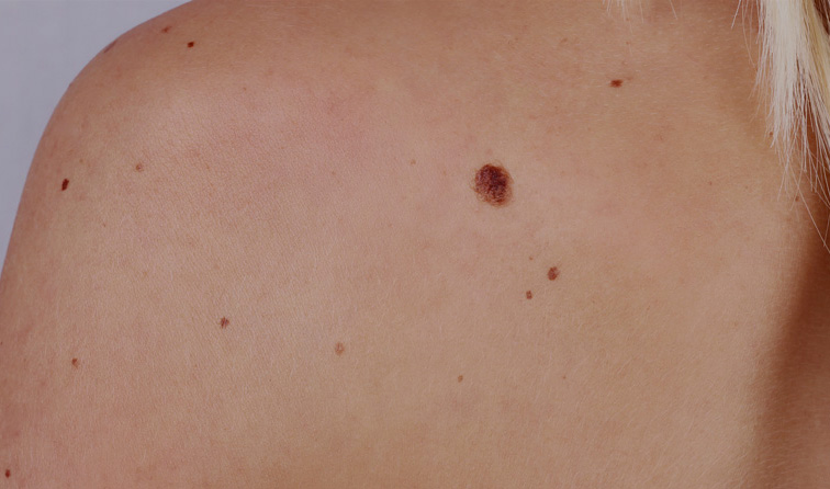 https://www.pacificplasticsurgerygroup.ca/wp-content/uploads/2024/03/moles.jpg