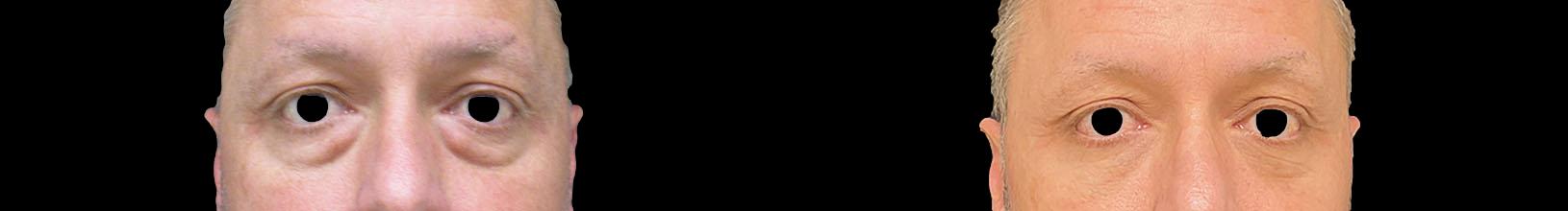 before and after blepharoplasty