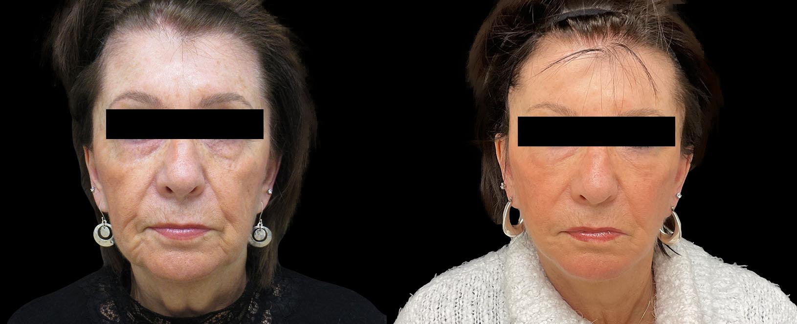 before and after facelift amp necklift