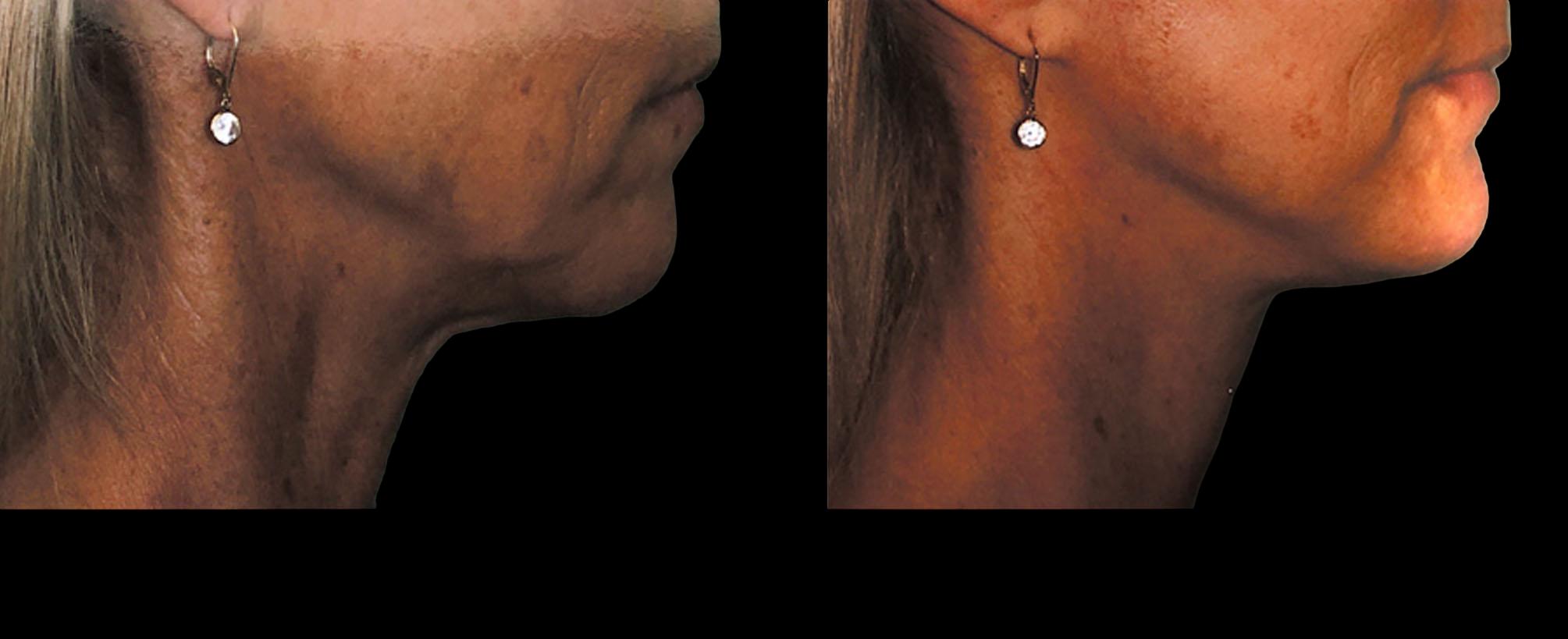 before and after facelift amp necklift